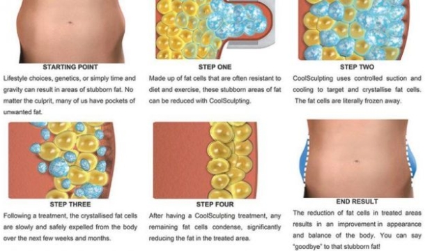Chilling the Fat: Exploring the Magic of Cool Sculpting