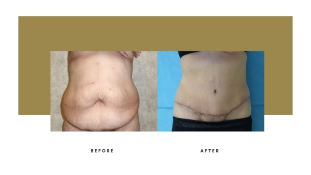 Tummy Tuck: A New Beginning for Your Midsection