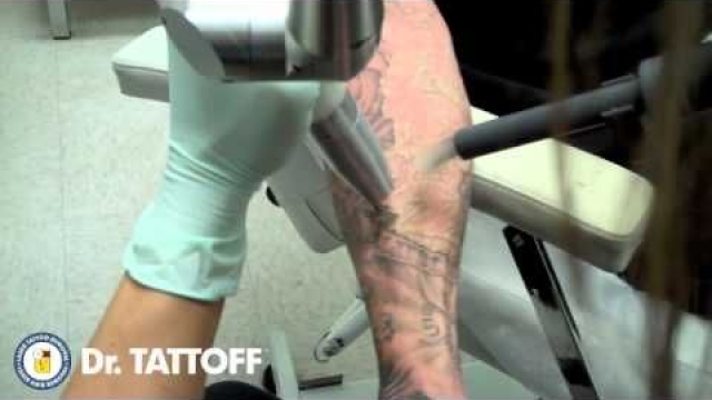 Your Tattoo Laser Removal Cost Needn’t Break The Actual