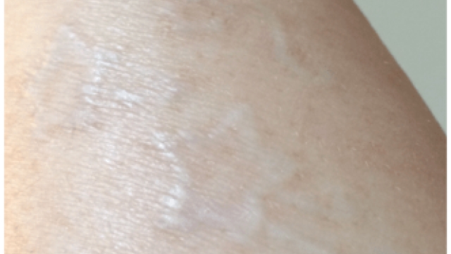 Are Tattoo Removal Creams Safe?