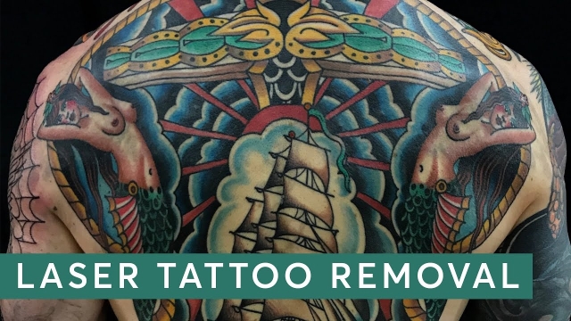 Find The Pros And Cons Of Tca Tattoo Removal